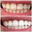 Отбеливание зубов Magic White 4